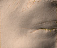 Skin condition around the eyes after wrinkle improvement