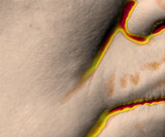 Nasolabial fold condition before wrinkle improvement