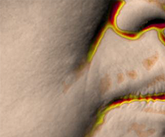Nasolabial fold condition after wrinkle improvement